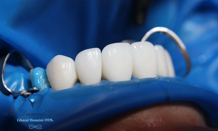 Is porcelain suitable for dental bridges?