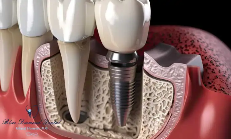 Dental single implant