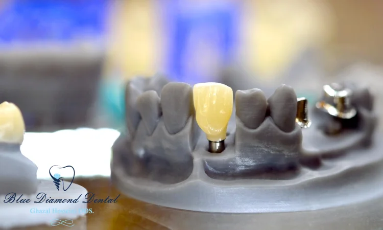 When would you need a dental crown?