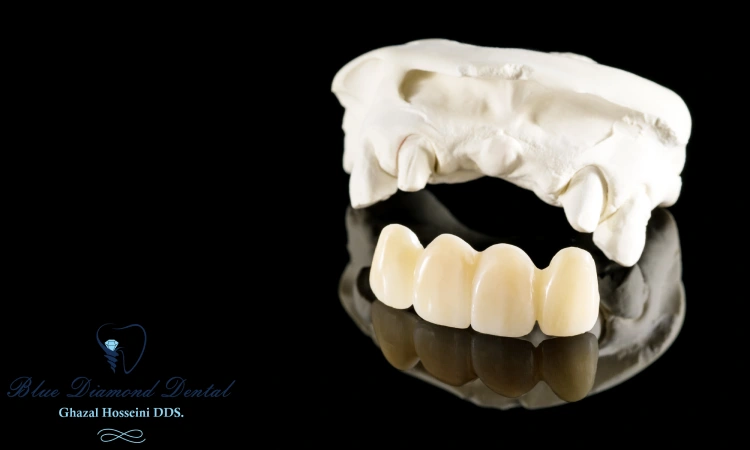 How long does a Dental porcelain crown last?