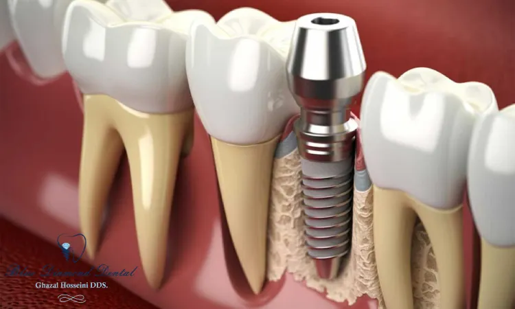 How long does a single dental implant last?