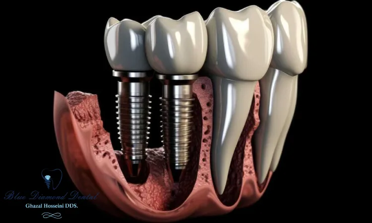 What are the steps in dental implant surgery?