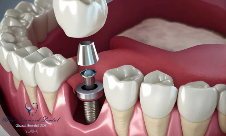 What are the 3 stages of dental implants?