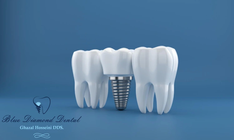 Types Of Crowns For Implants