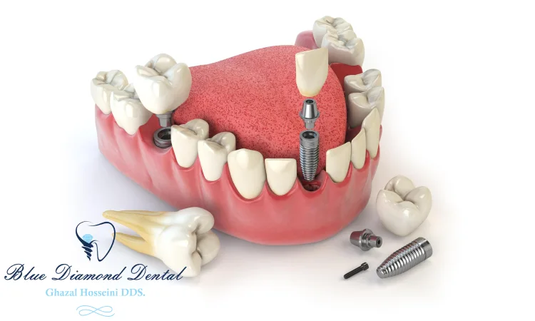 How long do implant crowns last?