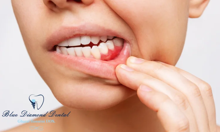 What are the signs and symptoms of gum disease and how is it diagnosed?