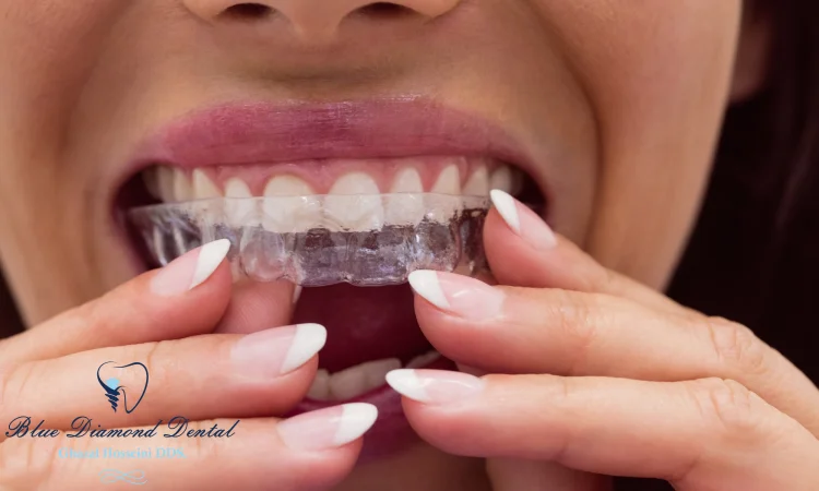 Is Invisalign a good treatment?