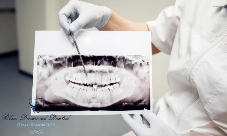 Is dental bone grafting worth it?