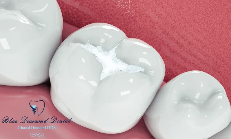 Which teeth filling is best?