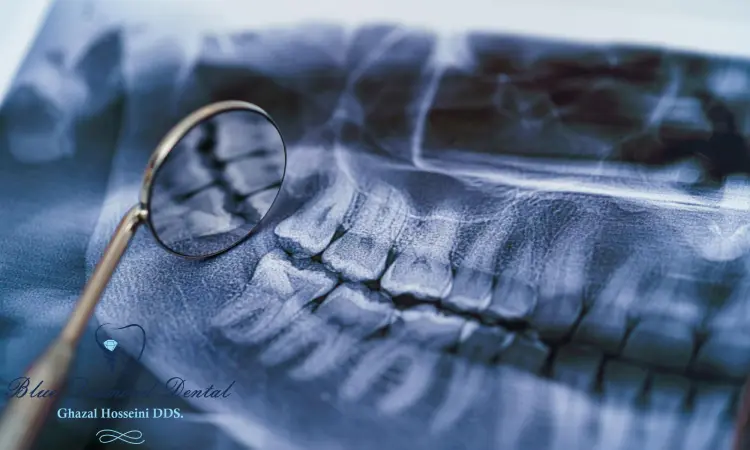 Is dental bone grafting painful?
