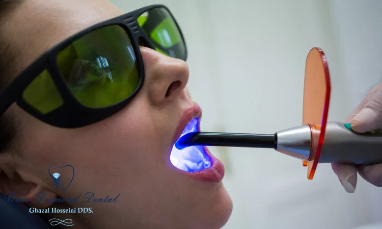 How long does Zoom whitening last?