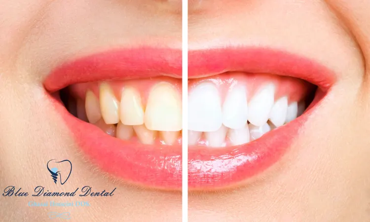 What happens during teeth whitening?