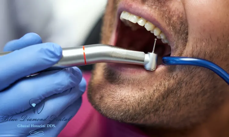 What are the types of dental sealants?