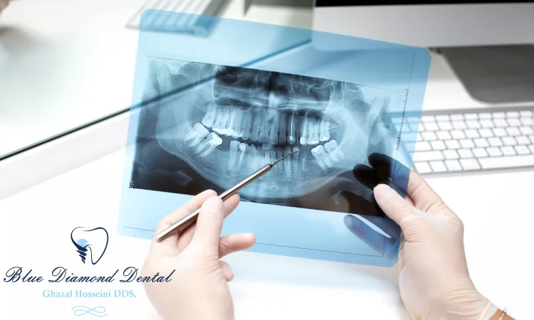 How often do you need full mouth dental x-rays?