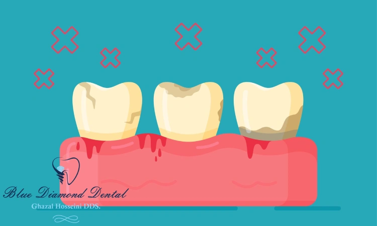 What To Do After Chipping a Tooth