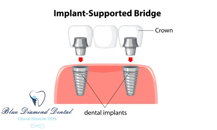 Costs of Implant-Supported Bridge (Anterior- CAD/CAM)