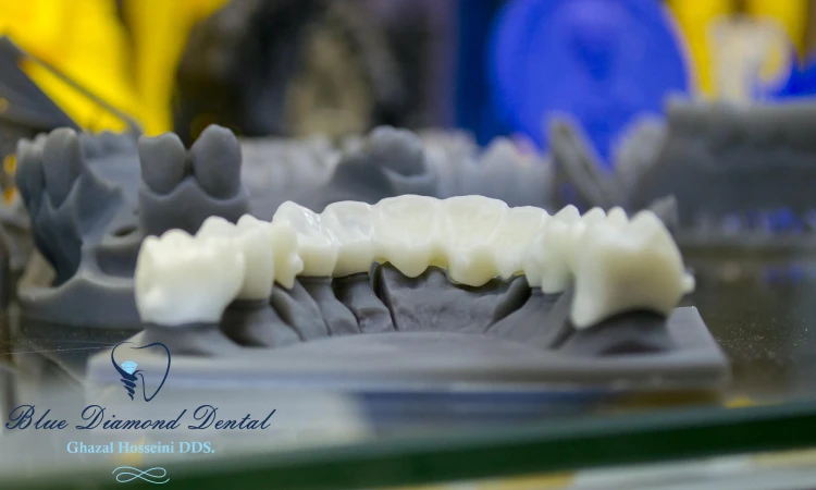 Results of Implant-Supported Bridge (Anterior- CAD/CAM)