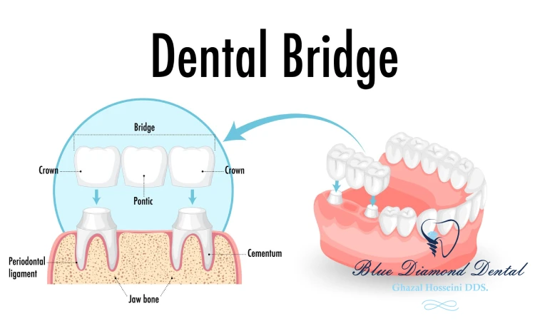 What is a dental bridge?