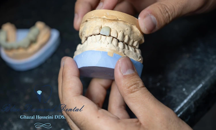 Overview about Bar retained overdentures