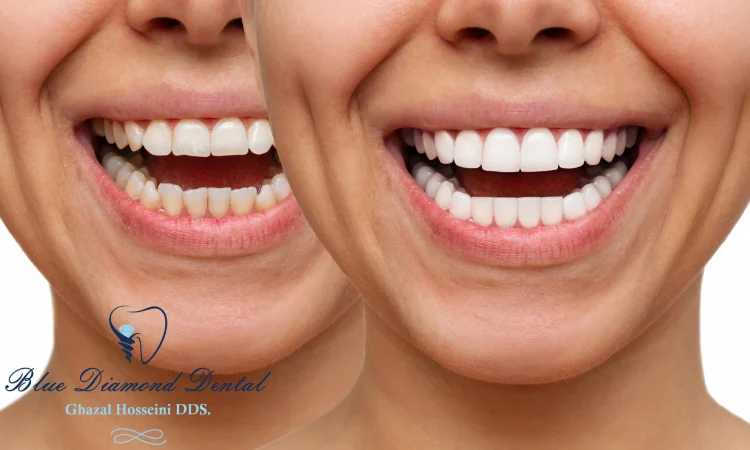 Compare Dental Veneers vs Dental Bonding