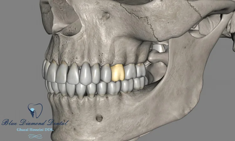 Full Mouth Reconstruction with Dental Implants