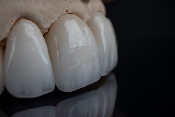 Dental Crown Materials FAQs